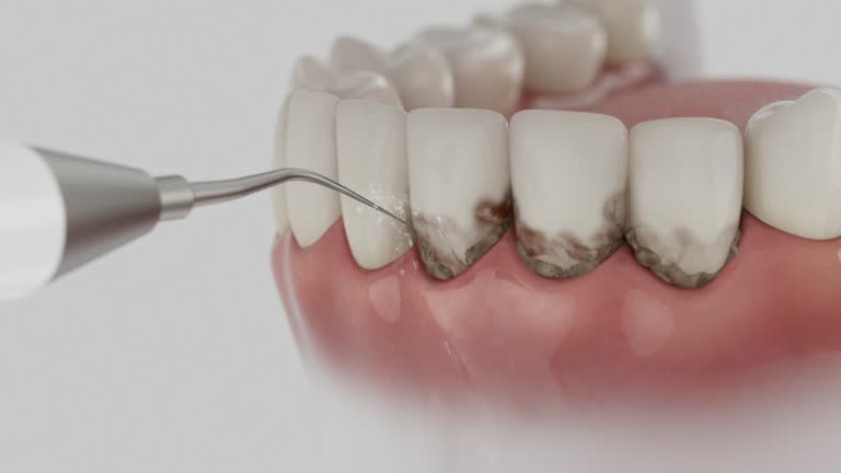 Reliable Wisdom Tooth Removal contractor in Soquel, CA by Smile Center Dentistry